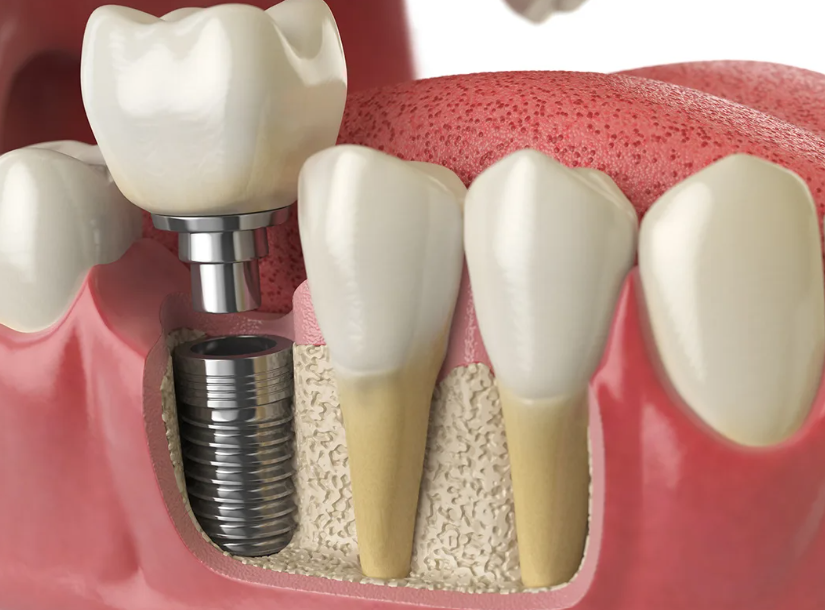 Dental implants