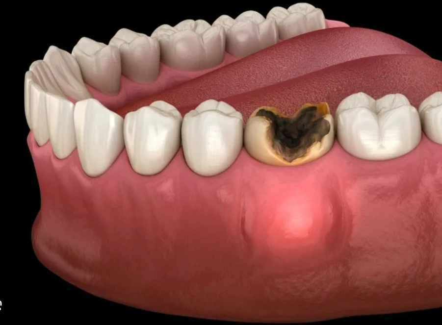 A model for an infected tooth.